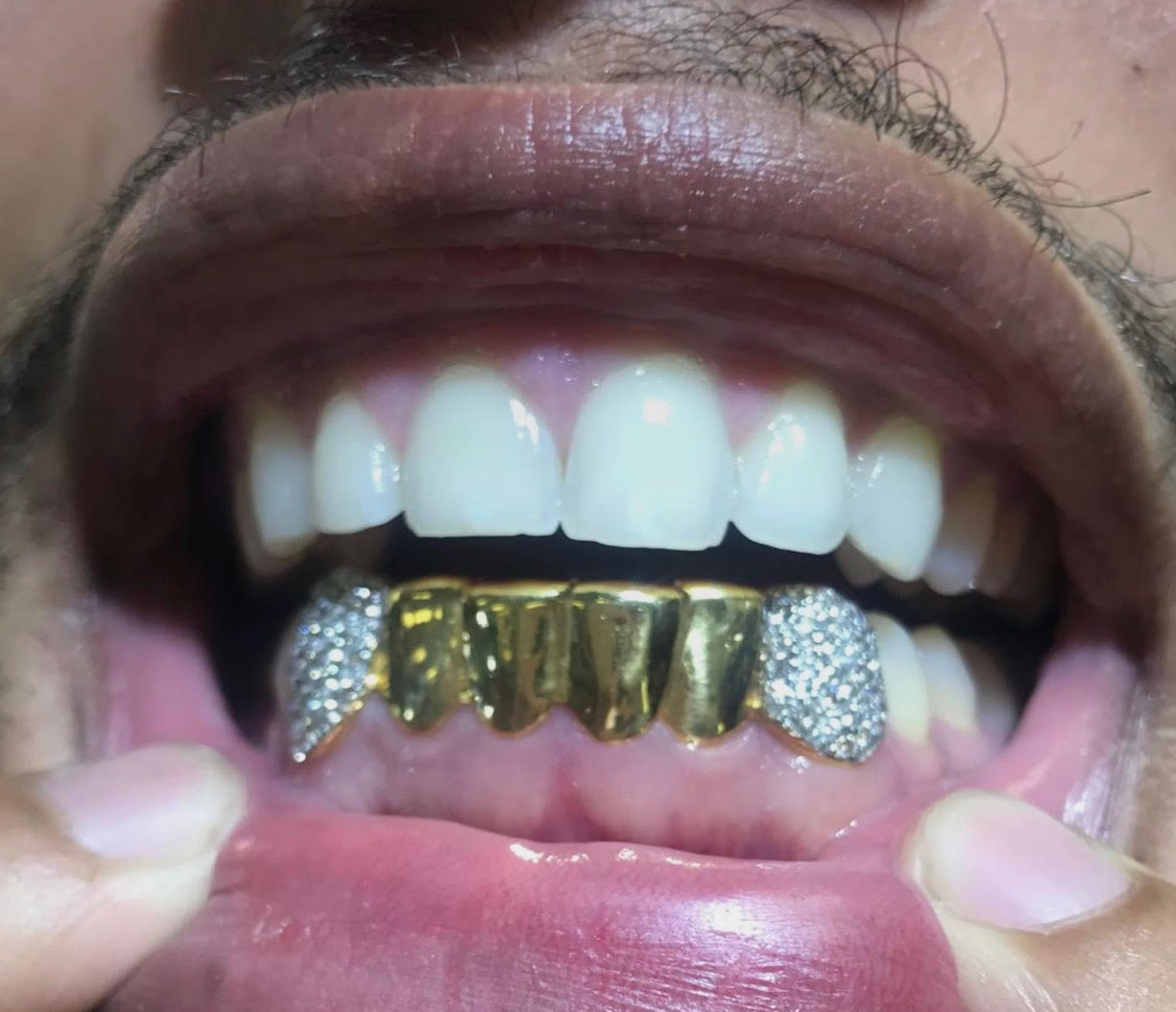 6 Piece Gold with 2 Natural Diamond Fangs